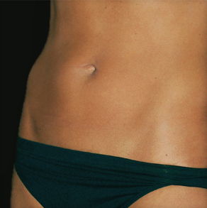 🥇 Johns Creek GA Tummy Tuck Surgery