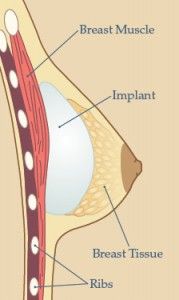 Breast Implant Placement Option