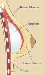Breast Implant Placement Option