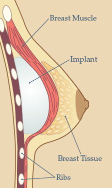 Breast implant placing