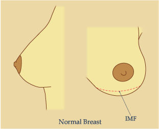 Picture Showing Normal Breast IMF