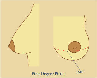 Picture Showing First Degree Ptosis