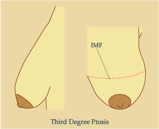 Picture Showing Third Degree Ptosis