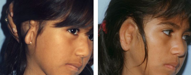 Girl's congenital ear deformities corrected
