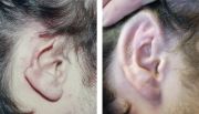 Atlanta Ear Reconstruction