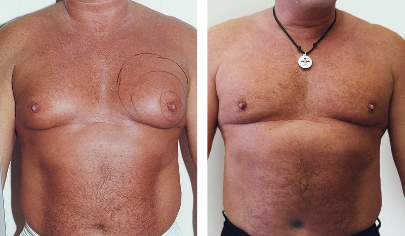 Nipple Correction Surgery Atlanta, GA