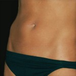 tummytuck