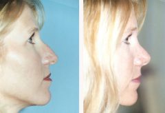 Rhinoplasty Patient 1 Before & After photos