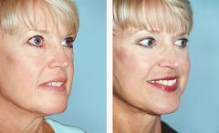 Facelift Patient 1 Before & After photos