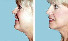 Facelift Patient 1 Before & After photos
