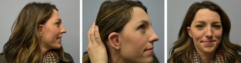 Woman Showing Ear After Microtia Surgery Atlanta