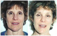 Facelift Patient 3 Before & After photos