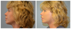 Facelift Patient 4 Before & After photos