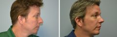 Rhinoplasty Patient 5 Before & After photos