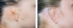 Microtia Patient 5 Before & After photos