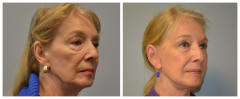 Facelift and Blepharoplasty Patient 5 Before & After photos