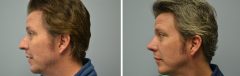 Rhinoplasty Patient 5 Before & After photos