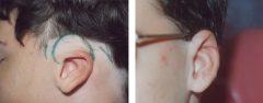Cryptotia (Specialized Version of Microtia) Patient 6 Before & After photos