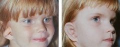 Microtia Patient 8 Before & After photos