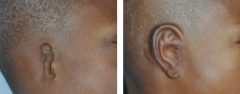 Microtia Patient 9 Before & After photos
