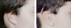 Microtia Patient 11 Before & After photos