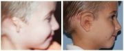 Microtia Patient 12 Before & After photos
