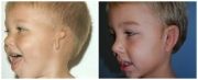 Microtia Patient 14 Before & After photos