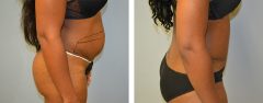 Tummy Patient 13 Before & After photos