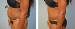 Tummy Patient 13 Before & After photos