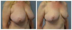 Breast Reduction Patient 8 Before & After photos
