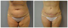 Tummy Patient 11 Before & After photos