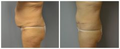 Tummy Patient 11 Before & After photos