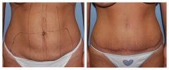 Tummy Patient 7 Before & After photos