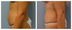 Tummy Patient 8 Before & After photos