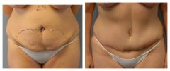 Tummy Patient 9 Before & After photos