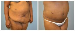 Tummy Patient 10 Before & After photos