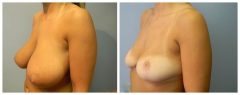 Breast Reduction Patient 5 Before & After photos