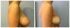 Breast Reduction Patient 5 Before & After photos