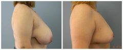 Breast Reduction Patient 6 Before & After photos