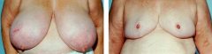 Breast Reduction Patient 2 Before & After photos