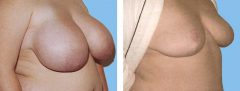 Breast Reduction Patient 1 Before & After photos