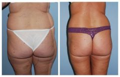 Tummy Patient 2 with Liposuction Before & After photos