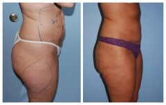 Tummy Patient 2 with Liposuction Before & After photos