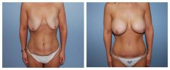 Patient 3 with Breast Augmentation Before & After photos