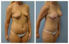 Patient 4 with Breast Augmentation Before & After photos