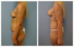 Patient 4 with Breast Augmentation Before & After photos