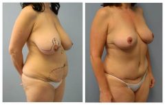 Patient 5 with Breast Augmentation Before & After photos