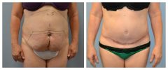 Tummy Patient 4 Before & After photos