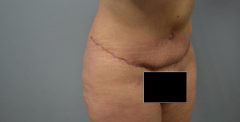 Tummy Patient 12 Before & After photos