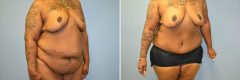 Patient 15 Abdominoplasty Before & After photos